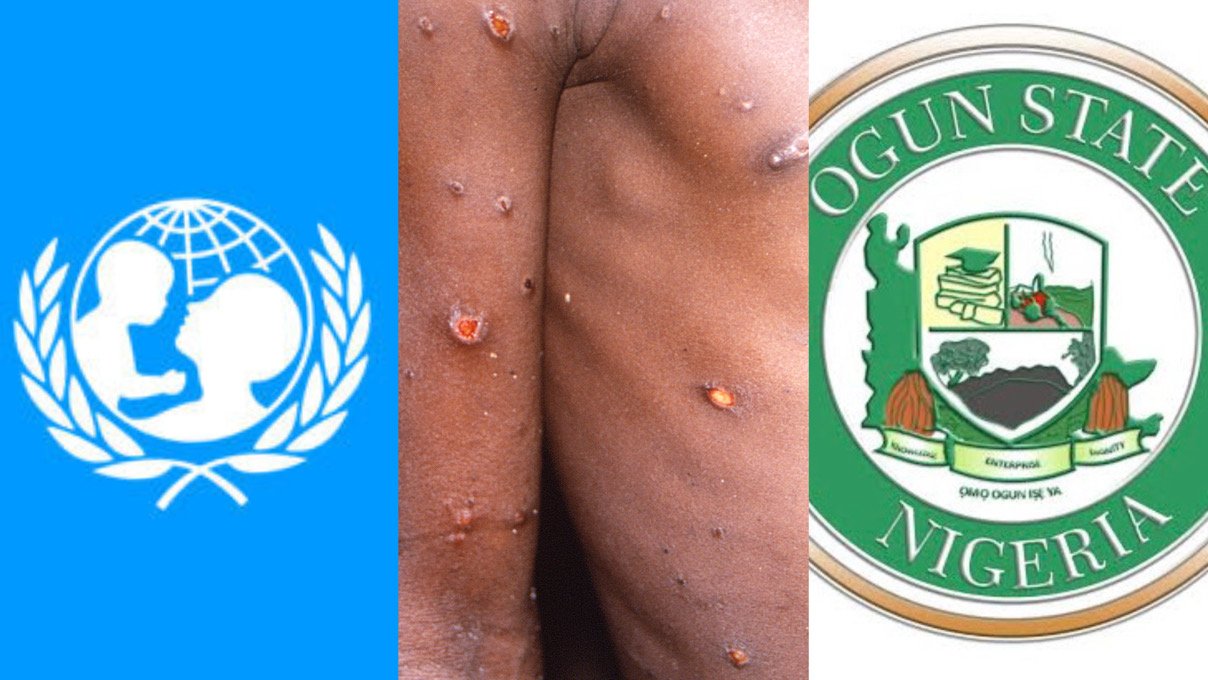 Ogun, UNICEF Partner Against Measles-Rubella, Set to Deploy 8,000 Workers